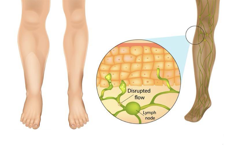 Jambes lourdes : causes, signes et solutions naturelles efficaces